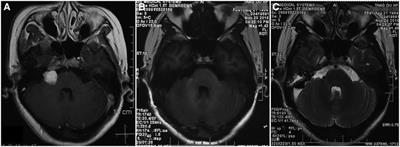 Unruptured anterior Inferior cerebellar artery aneurysm following stereotactic irradiation for vestibular schwannoma: Case report and literature review